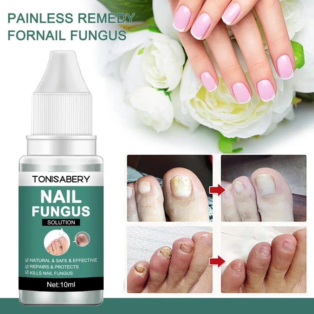 Nail Fungus Treatment Serum Foot Repair Liquid Toe Nails Fungal Removal Gel Anti Infection Paronychia Onychomycosis Cream 10ml