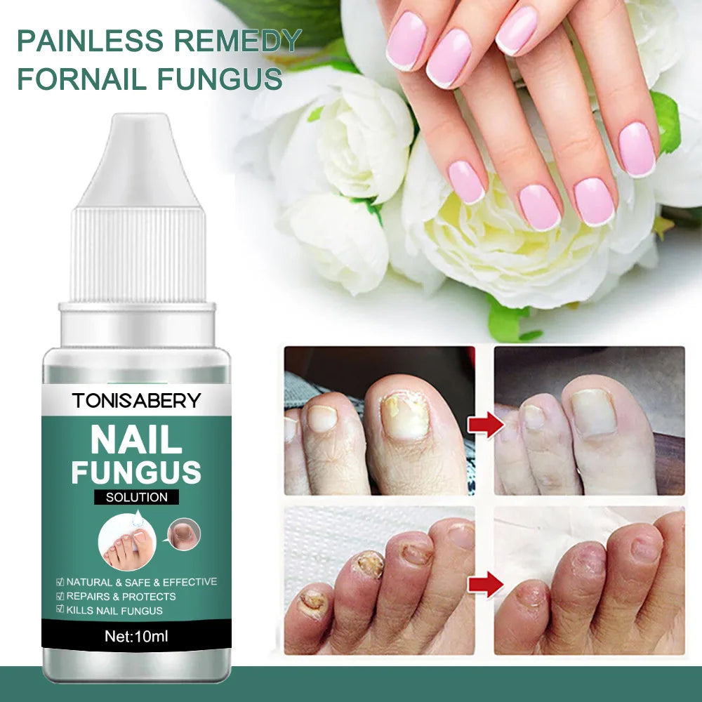 Nail Fungus Treatment Serum Foot Repair Liquid Toe Nails Fungal Removal Gel Anti Infection Paronychia Onychomycosis Cream 10ml