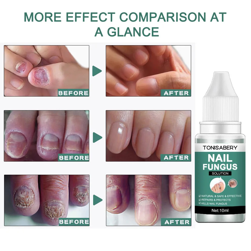 Nail Fungus Treatment Serum Foot Repair Liquid Toe Nails Fungal Removal Gel Anti Infection Paronychia Onychomycosis Cream 10ml