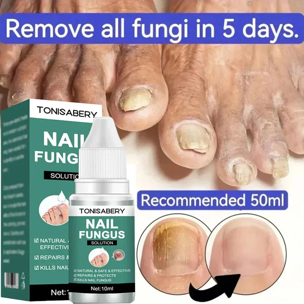 Nail Fungus Treatment Serum Foot Repair Liquid Toe Nails Fungal Removal Gel Anti Infection Paronychia Onychomycosis Cream 10ml