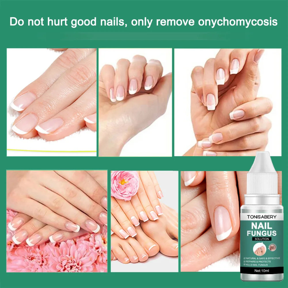 Nail Fungus Treatment Serum Foot Repair Liquid Toe Nails Fungal Removal Gel Anti Infection Paronychia Onychomycosis Cream 10ml